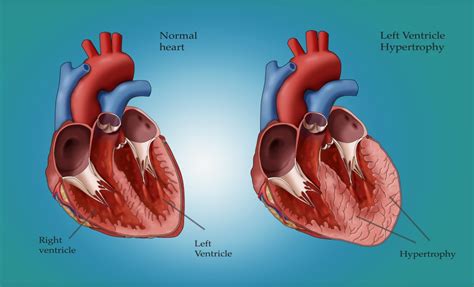 lv overload symptoms|lv hypertrophy heart.